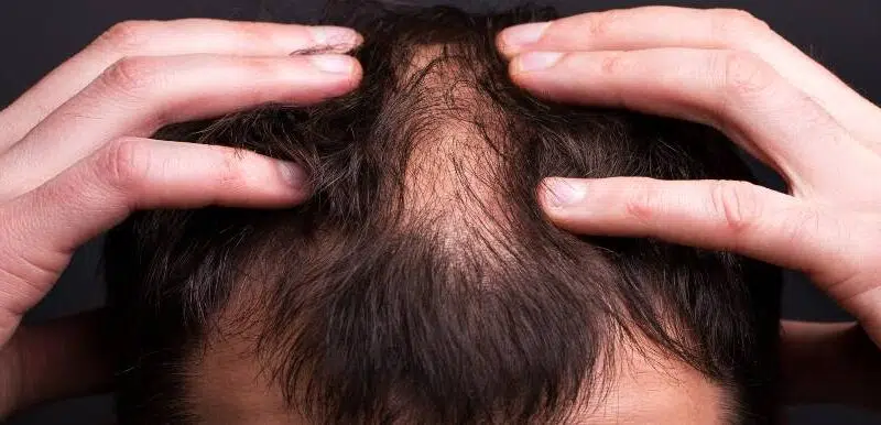 Why Nicotinamide Mononucleotide (NMN) might affect hair growth